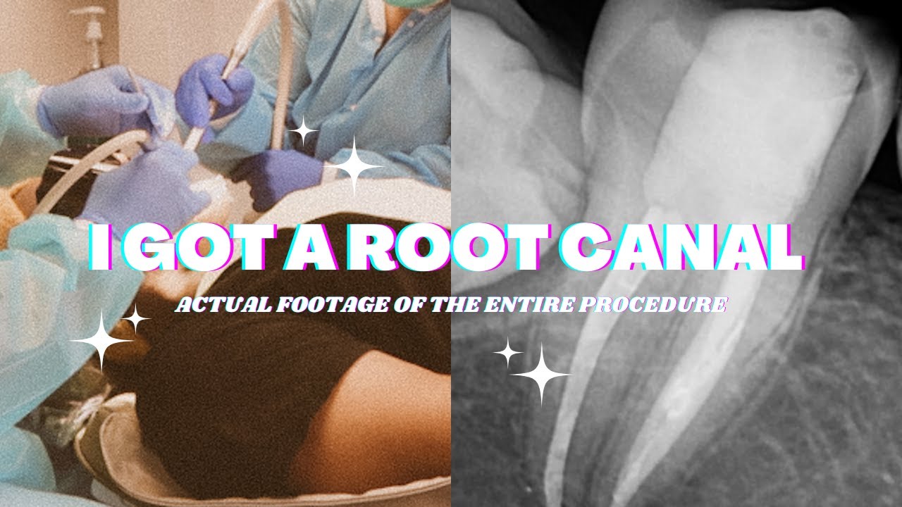 ACTUAL FOOTAGE OF MY ENTIRE ROOT CANAL EXPERIENCE + what it's like to get a root canal  | VLOG