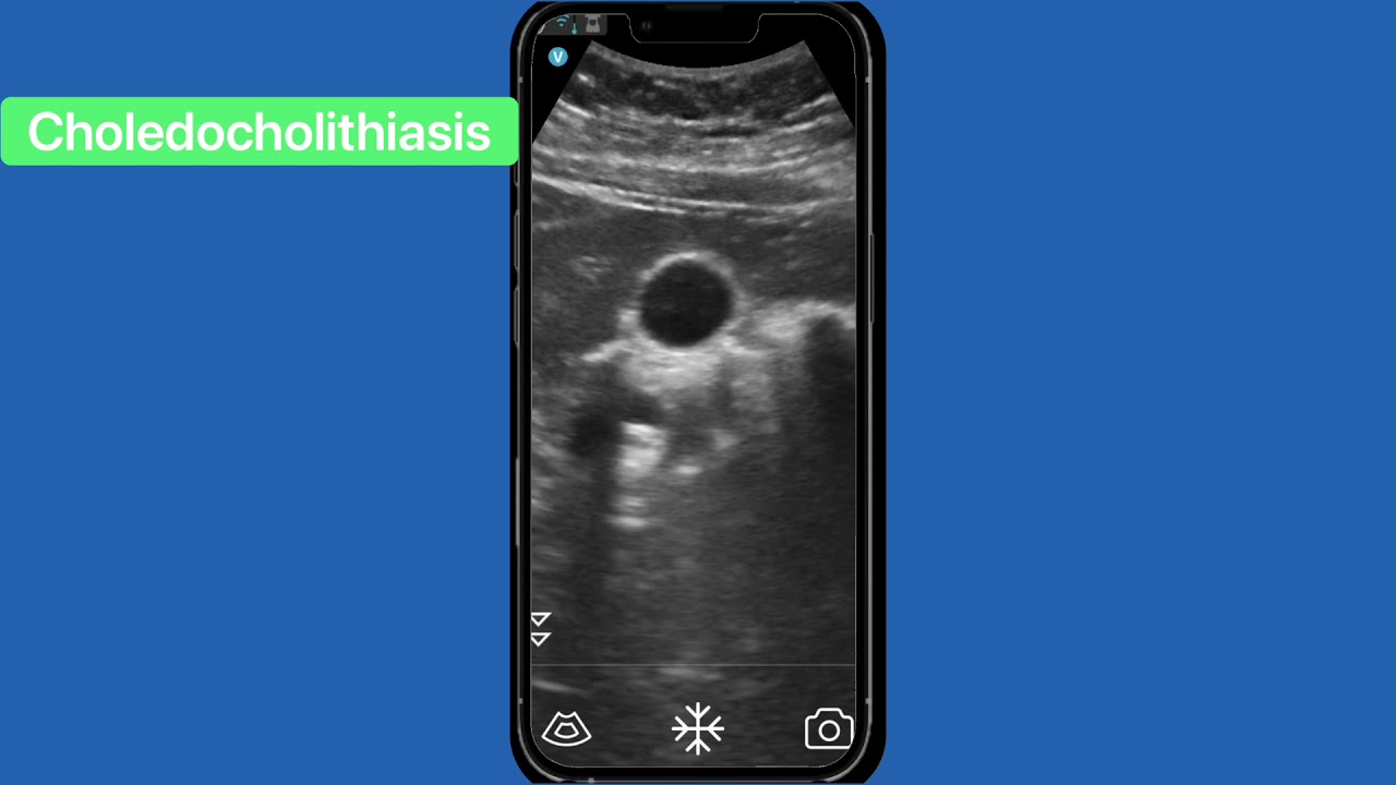 Choledocholithiasis with the Vscan