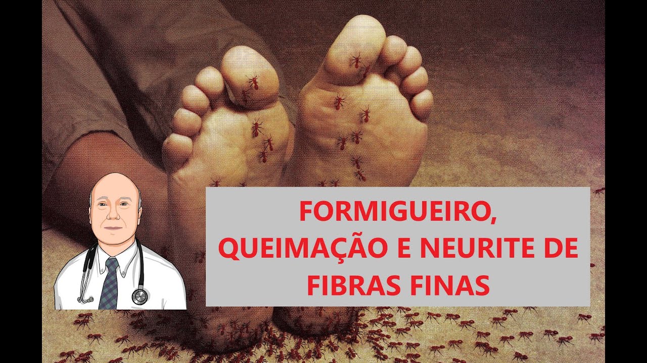 Queimação de mãos e pés, cansaço, dor nos intestinos: os sintomas da neuropatia de fibras finas.
