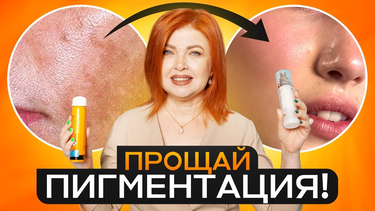 Избавься от ПИГМЕНТНЫХ пятен НАВСЕГДА! Лучшие средства для борьбы с пигментацией