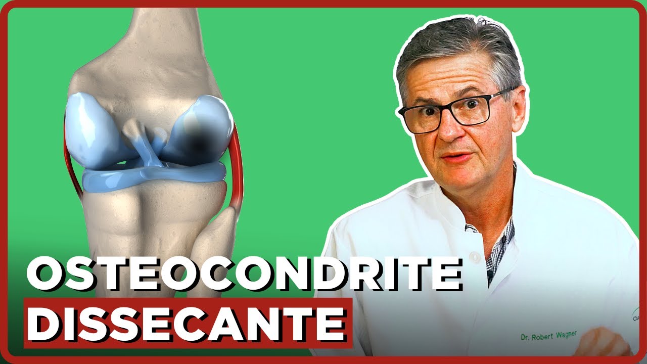Tudo sobre Osteocondrite Dissecante do Joelho | Simplificando Ortopedia