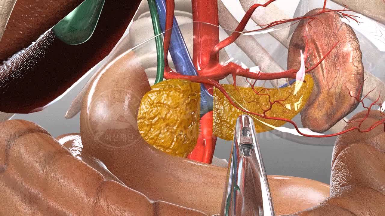 Pancreatic tail resection