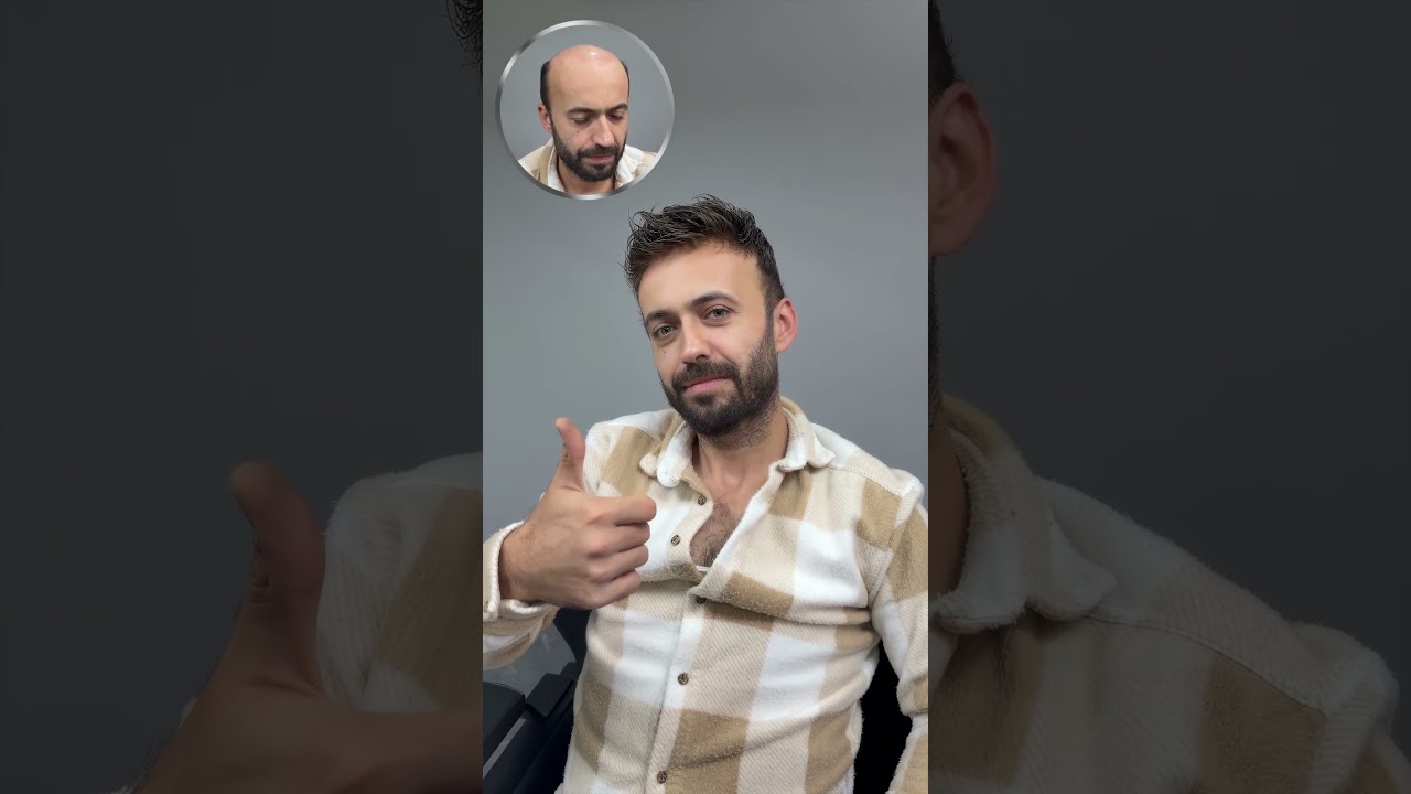 Best Hair Replacement Center in Turkey - S-Well Hair