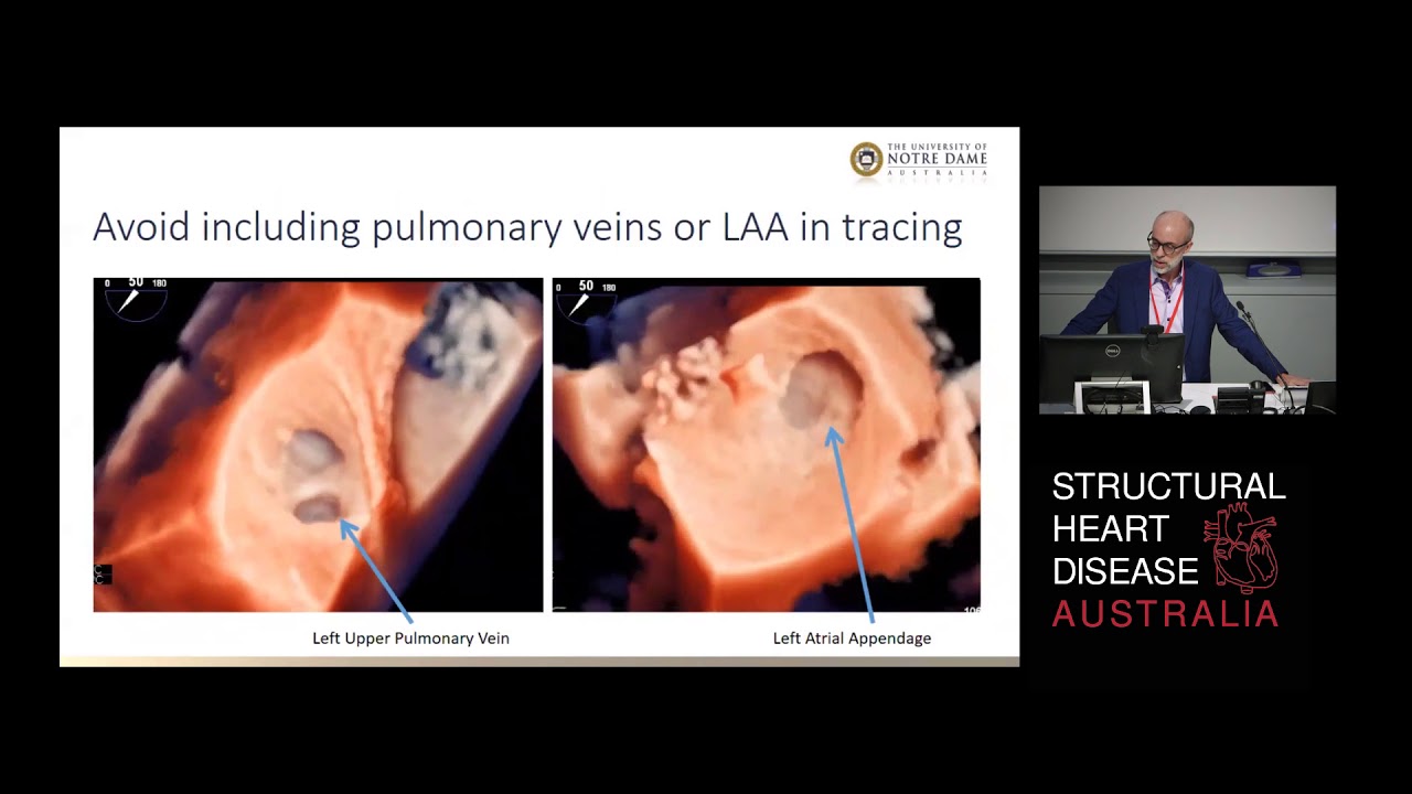 Measuring Left Atrial Volume is Important in Predicting Outcome - Prof David Playford