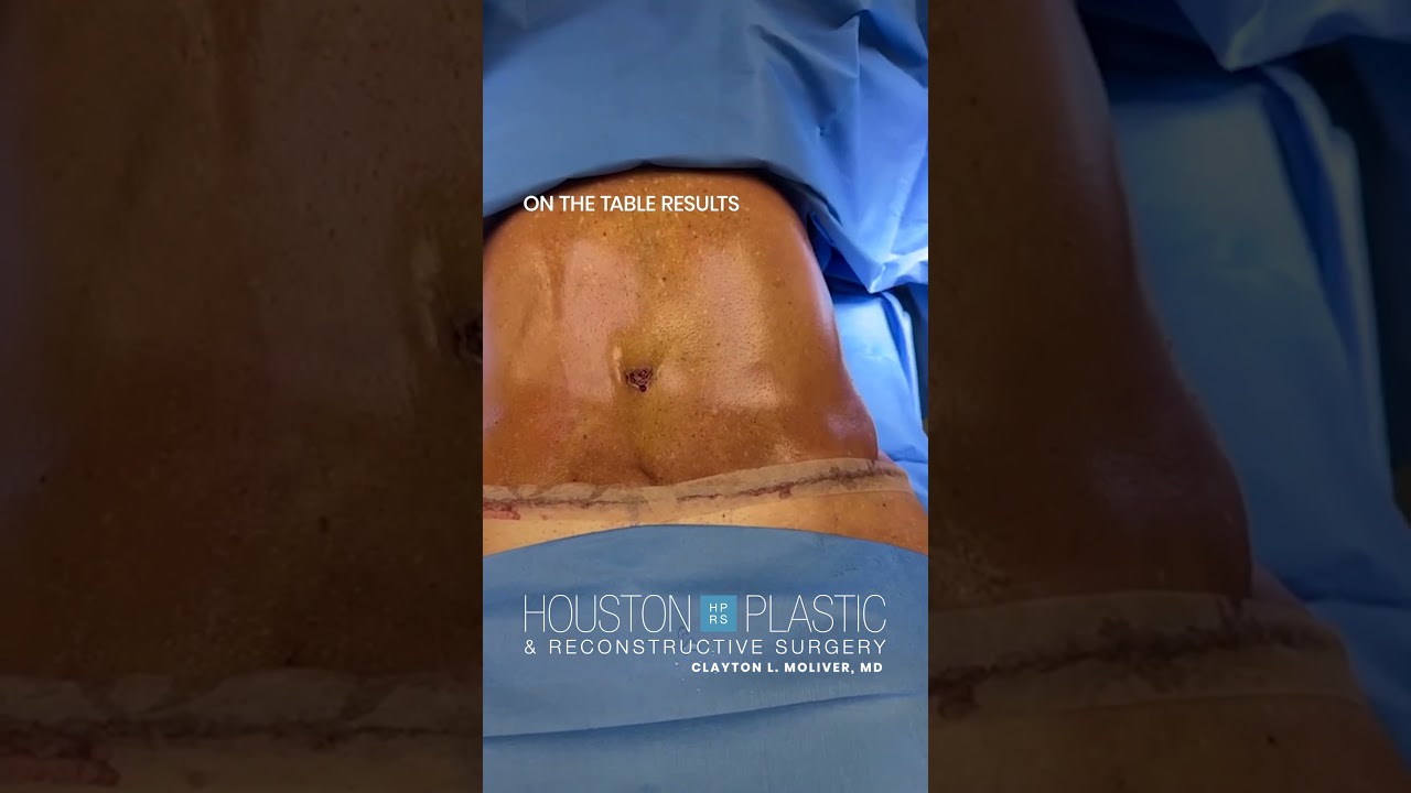 Before and Immediately after A Tummy Tuck surgery #tummytucksurgery #mommymakeover #weightloss