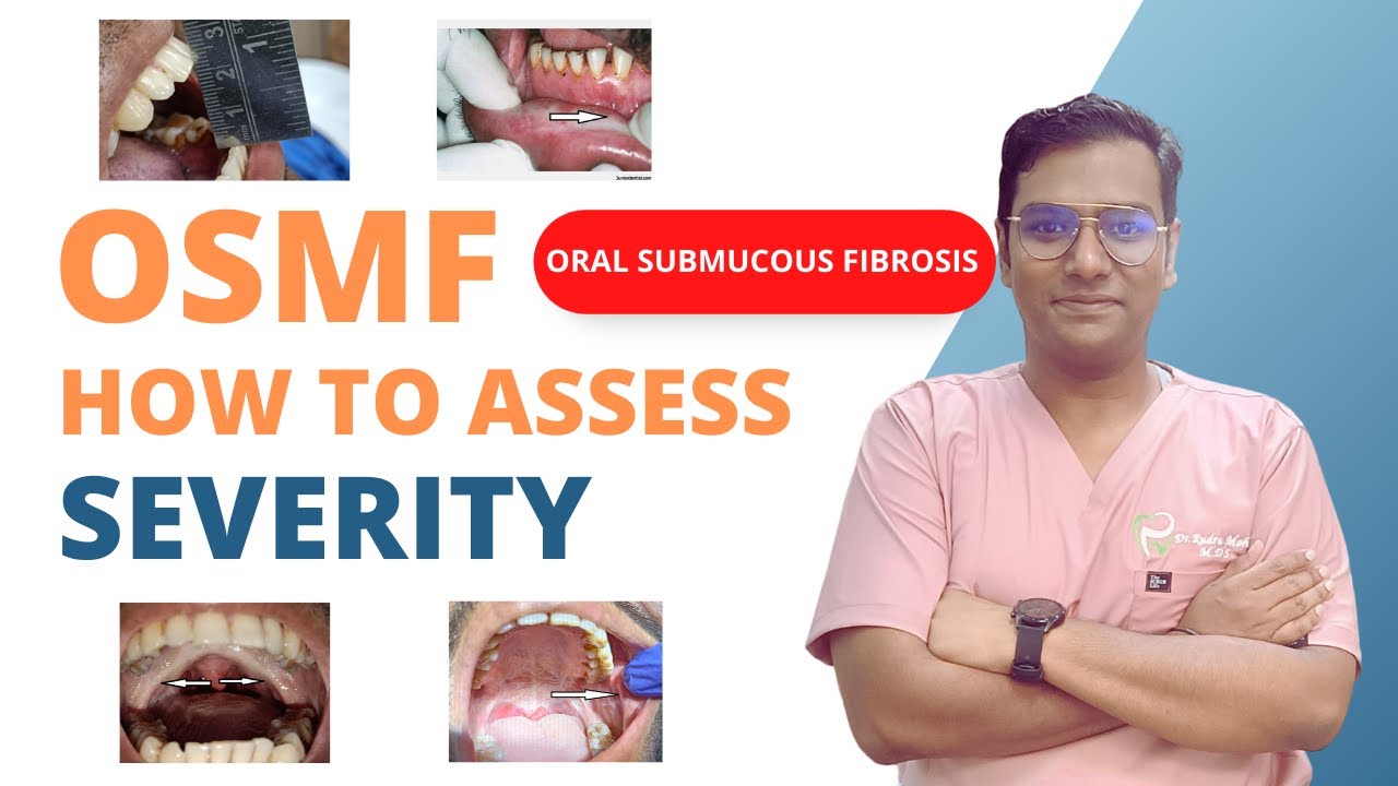 Dr Rudra Mohan | How to know the Stage and Severity of Oral Submucous Fibrosis | OSMF Staging