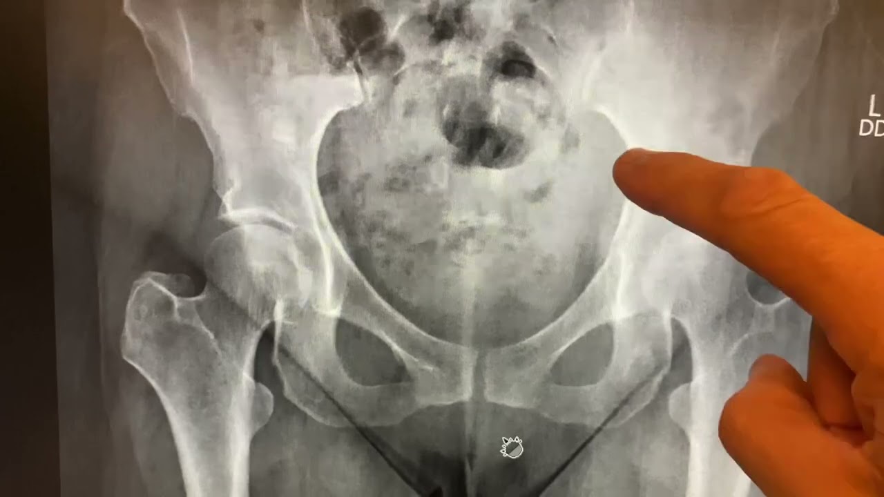 Plain X-Rays Can Help A lot More than You Think: A Bone Tumor Case. #MoraMD