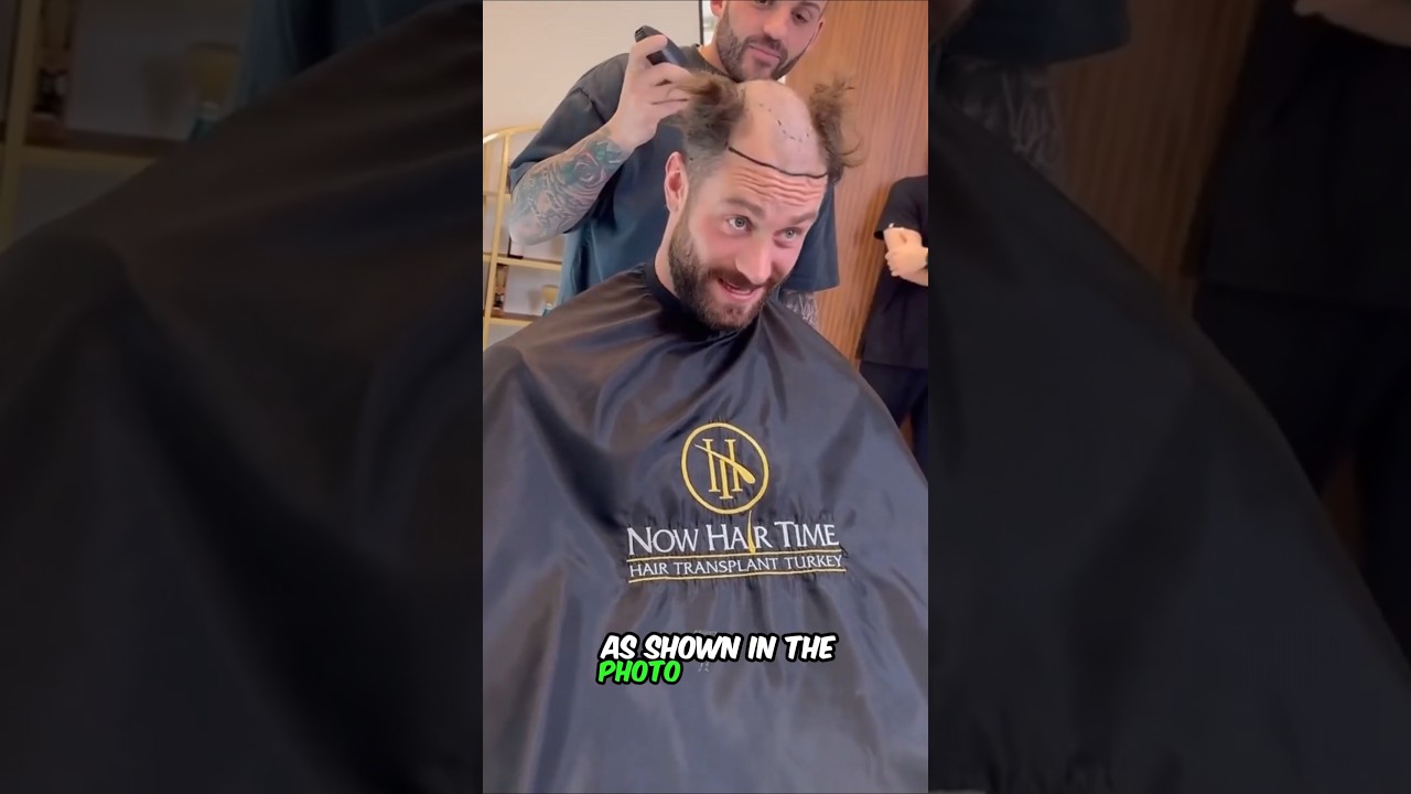This is why Chris Bumstead's Hair Transplant FAILED!... @ChrisBumstead