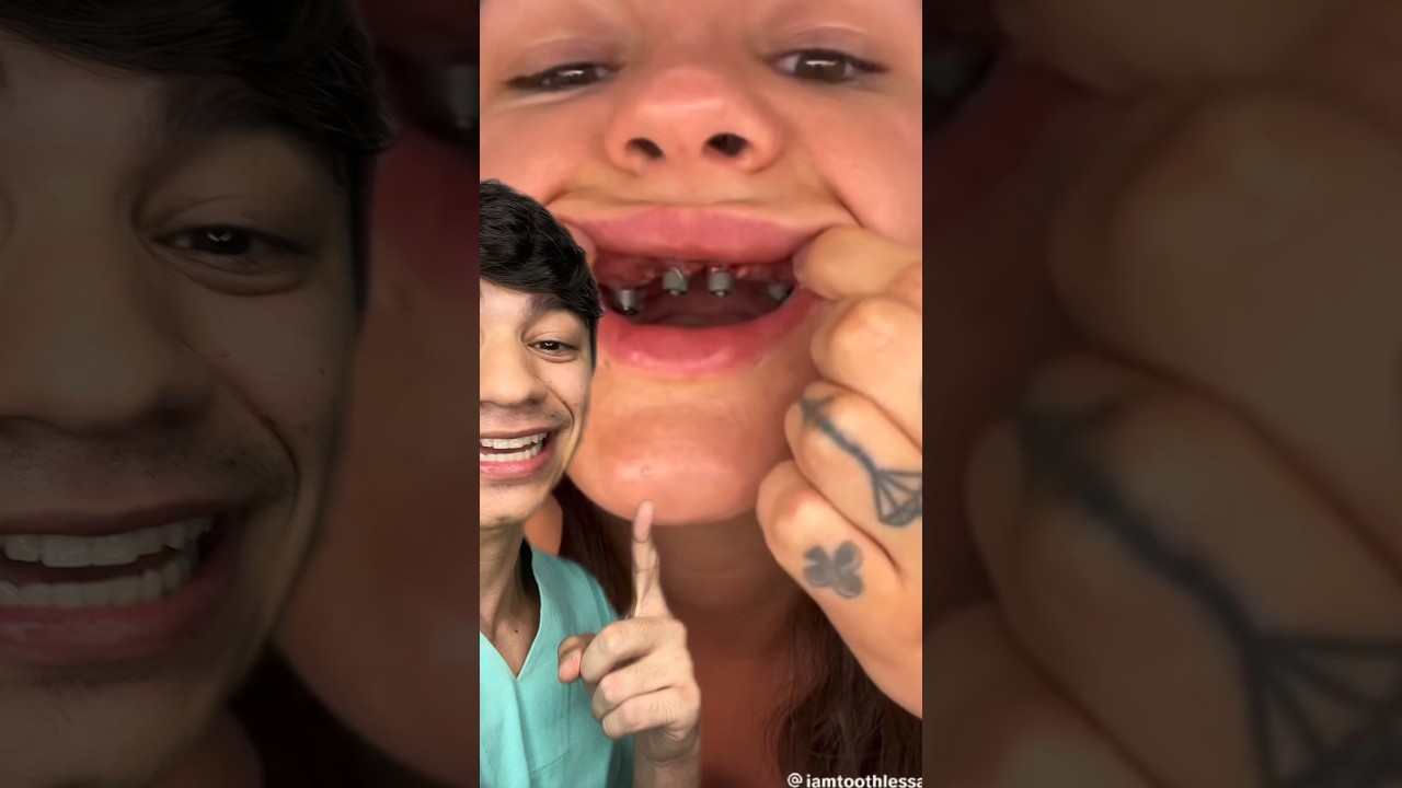 Influencer colocou Implantes em Toda Boca Parte 2!! ATUALIZAÇÃO #shorts