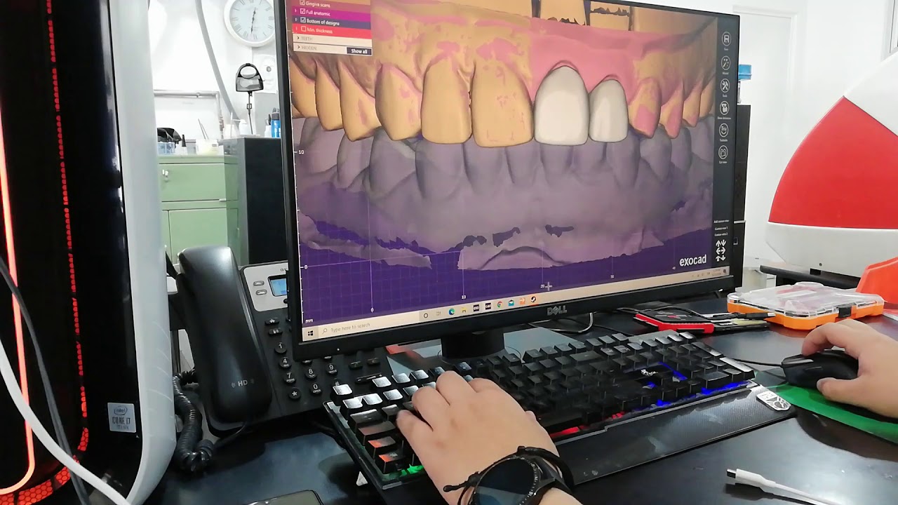 Proceso de Escaneo y diseño en laboratorio dental digital
