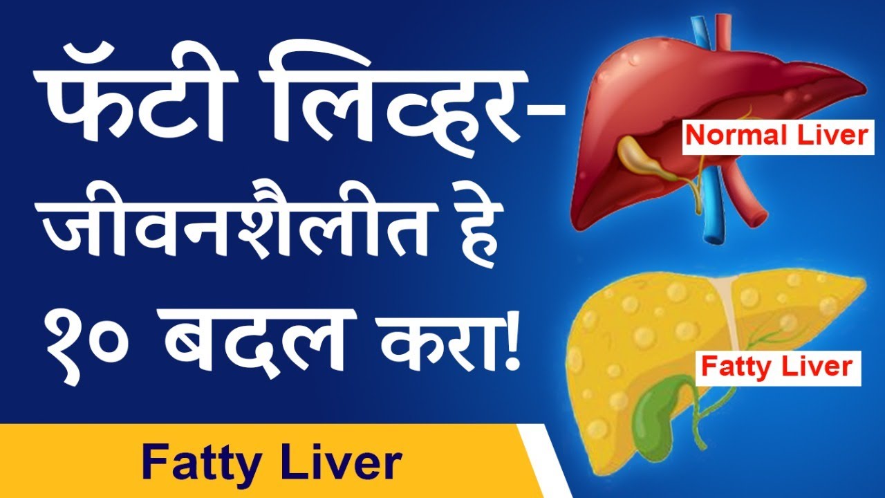 Top 10 tips for fatty liver  | फॅटी लिव्हर - जीवनशैलीत हे १० बदल करा! | Marathi |