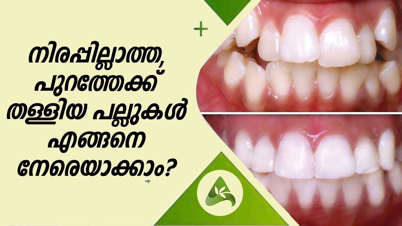 Dental Tips | നിരപ്പില്ലാത്ത, പുറത്തേക്ക് തള്ളിയ പല്ലുകൾ എങ്ങനെ നേരെയാക്കാം? | Arogya Kaumudy