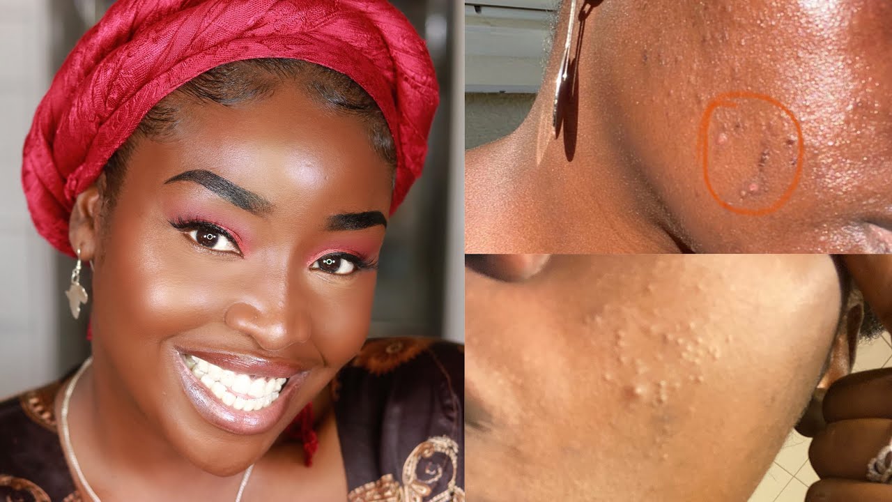 I RUINED MY SKIN!! | How I used Differin and Tetralysal to clear my skin again