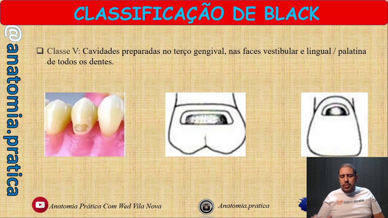 Classificação de Black - Preparo Cavitários - ASB/TSB - Anatomia Prática com Wed Vila Nova