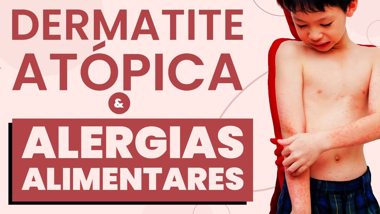 Dermatite atópica: o que a alimentação tem a ver com isso?