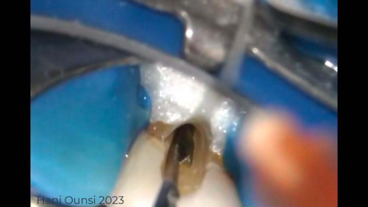 A guided approach to broken instrument retrieval using the BTR pen