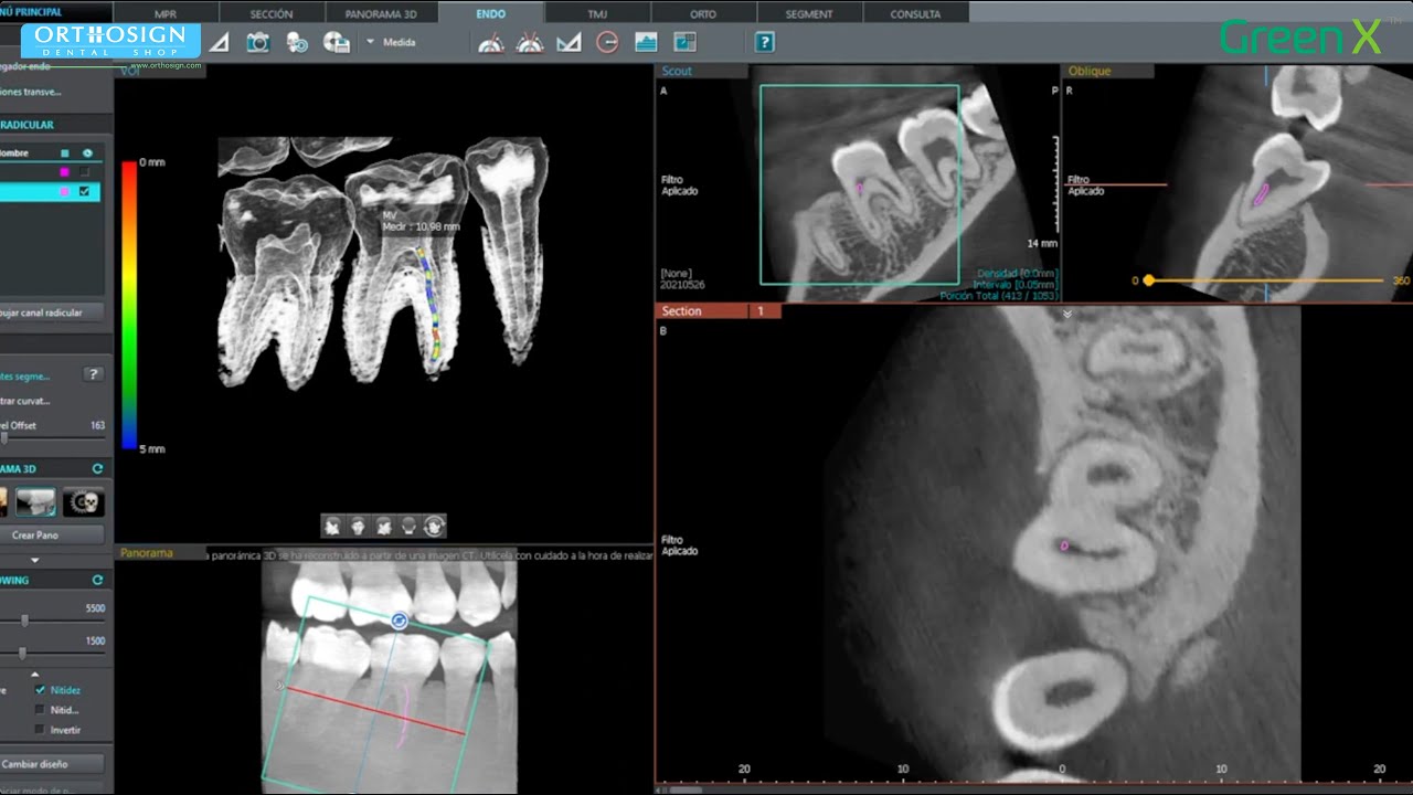 ¿Análisis para Endodoncia con Vatech Green X 3D Cone Beam + Panorámico + Ceph - Orthosign
