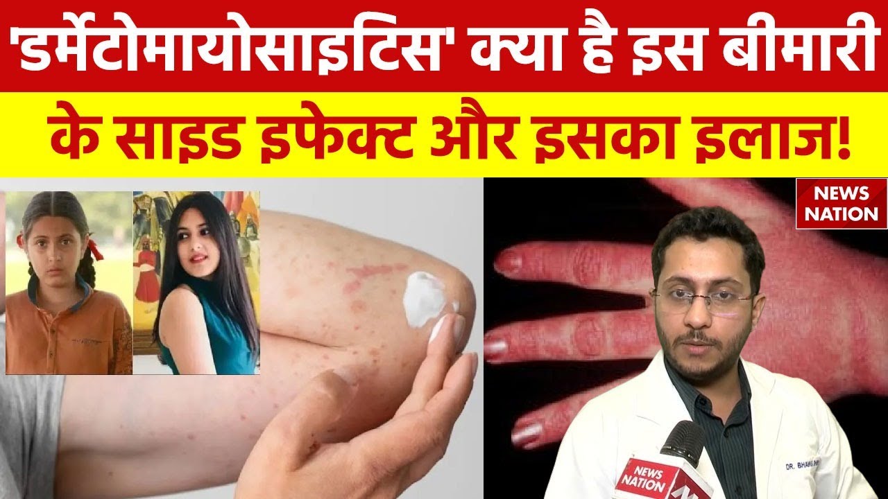 What Is Dermatomyositis: खतरनाक बीमारी है 'डर्मेटोमायोसिटिस', क्या है इसके लक्षण क्या है इसका इलाज?