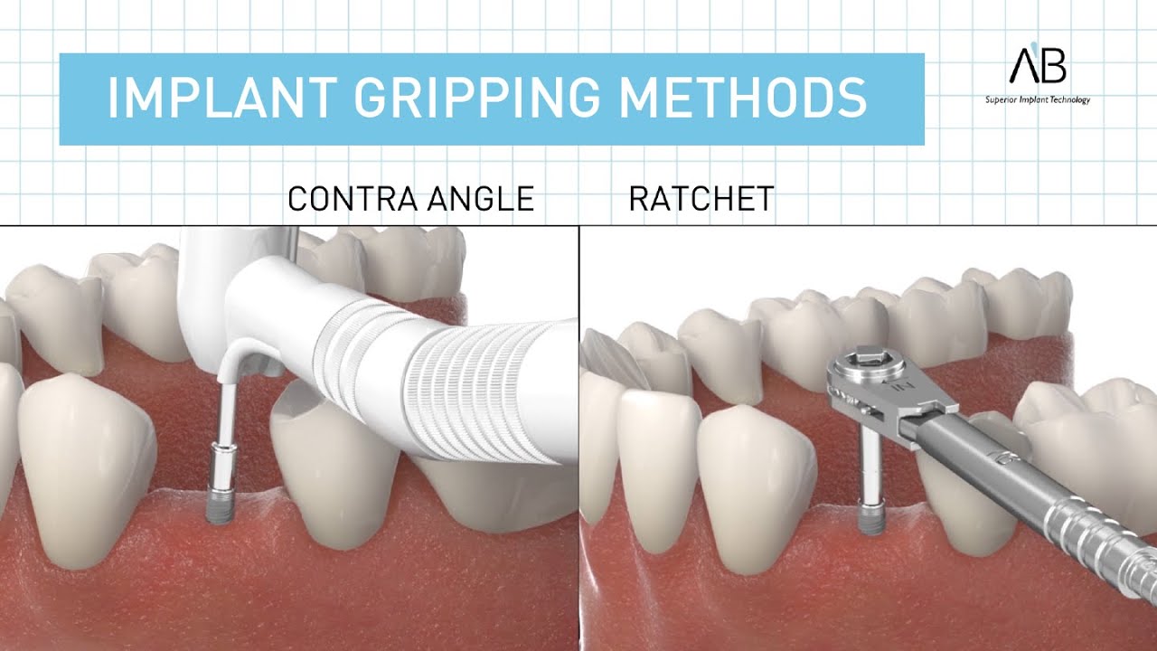 Dental Implant Insertion - Gripping Methods