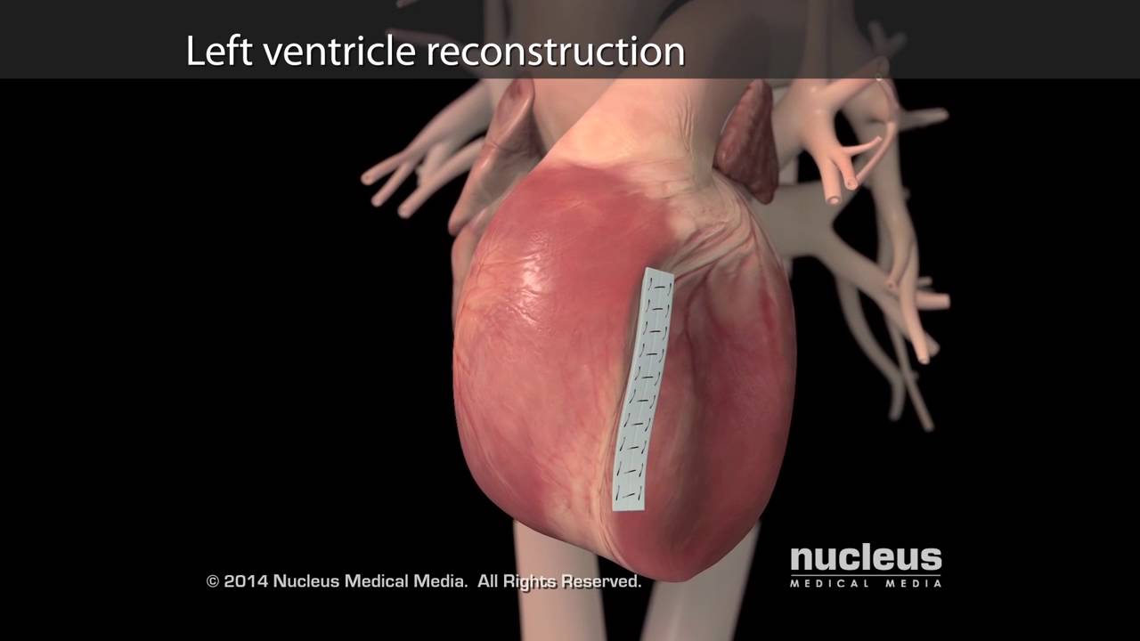 Asian Heart Hospital - What are Heart failure treatment procedures??