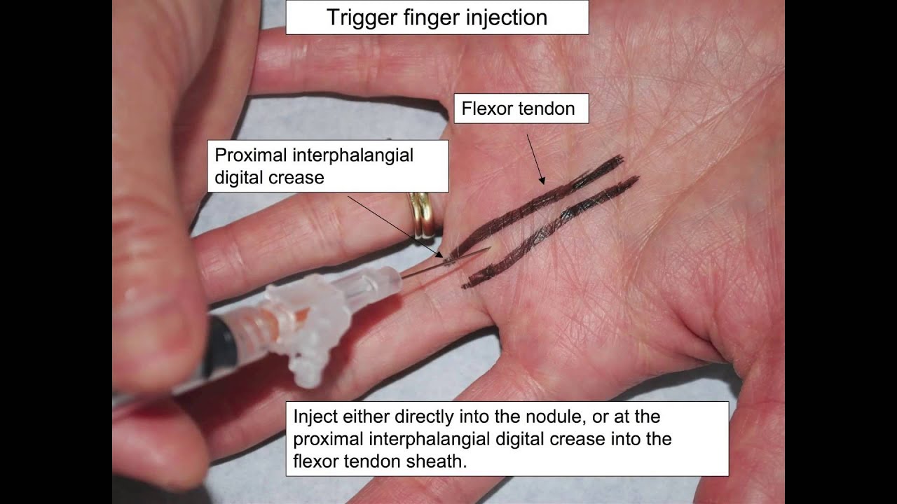 SdMskProject Trigger Finger