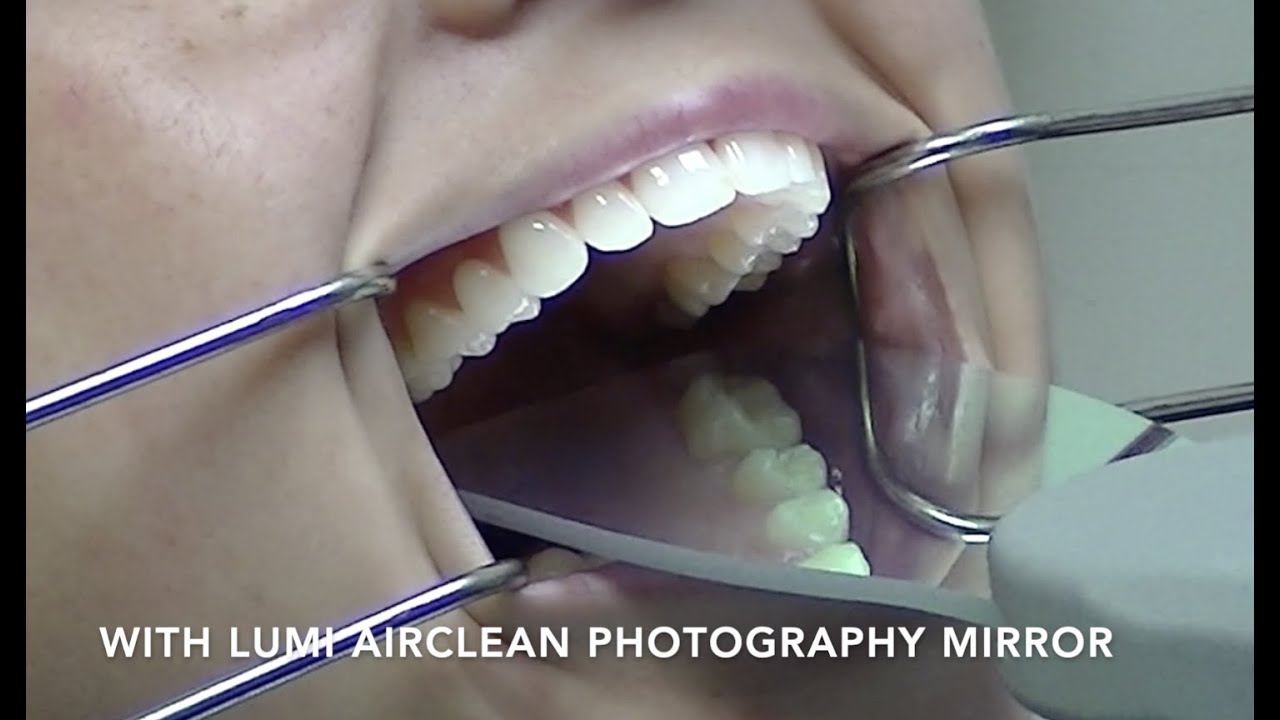 Dental Unboxing & Evaluation of Lumi AirClean Photography Mirrors, Dental Photography Mirrors
