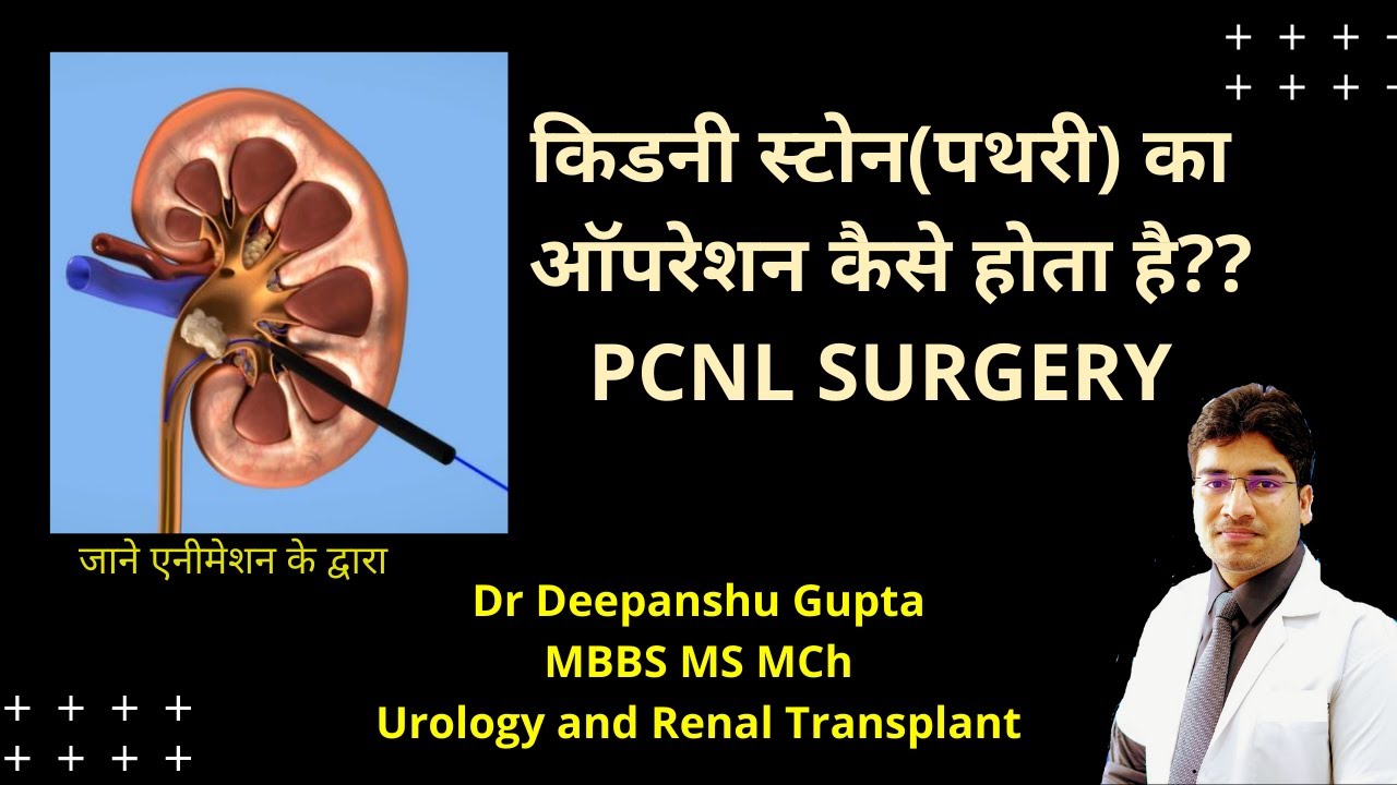 PCNL explained in Hindi I PCNL FOR KIDNEY STONE I percutaneous nephrolithotomy |Kidney stone surgery