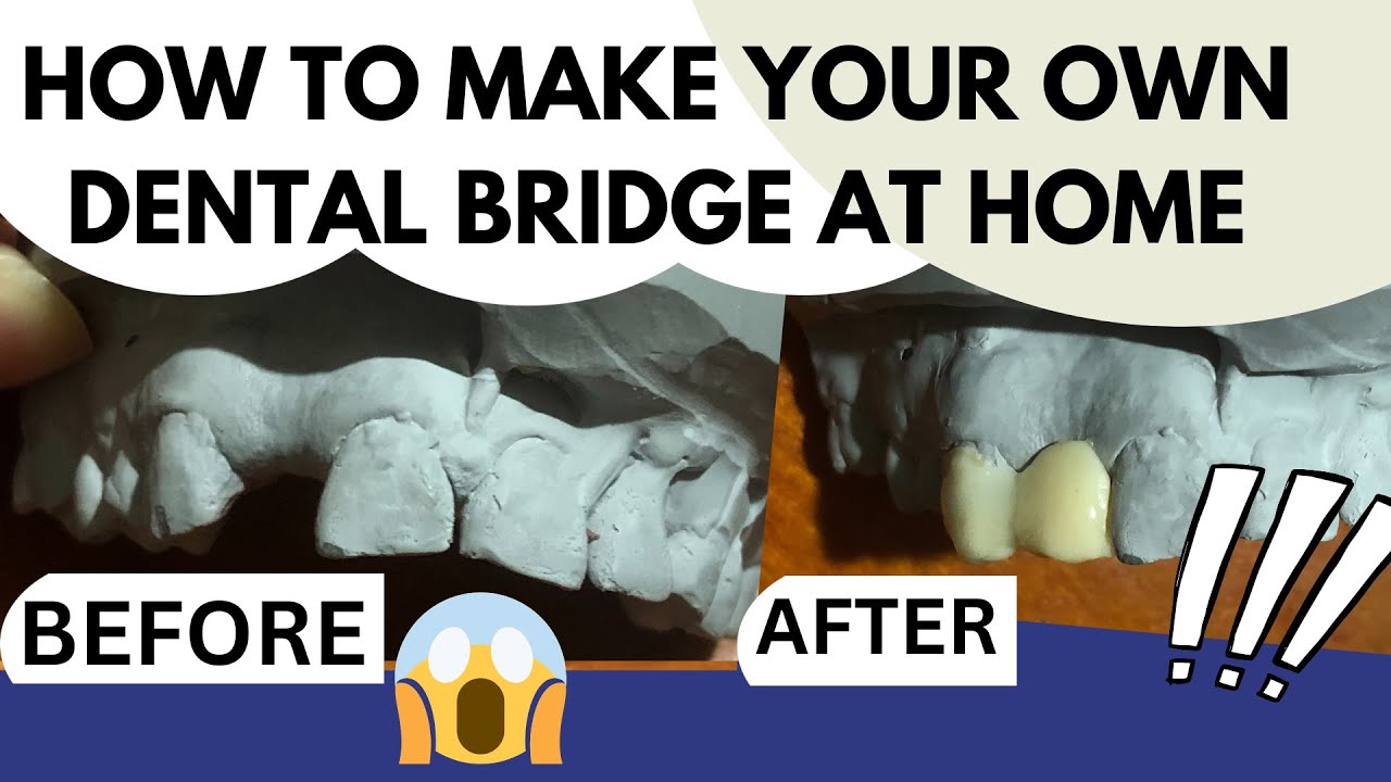 Make your Own DENTAL BRIDGE at home DIY! Easy and Realistic Custom made Resin Bridge