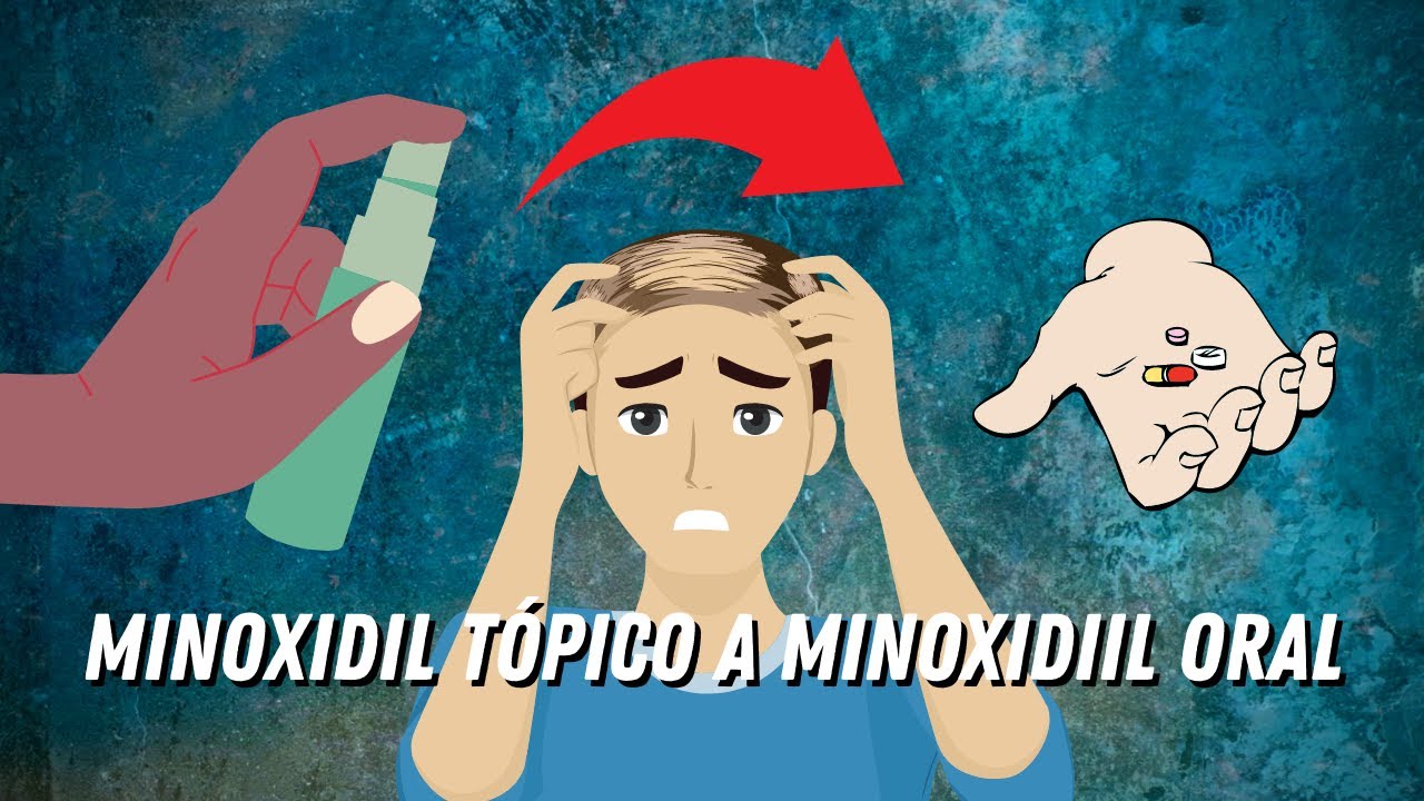 C&Oacute;MO CAMBIAR DE MINOXIDIL T&Oacute;PICO A MINOXIDIL ORAL