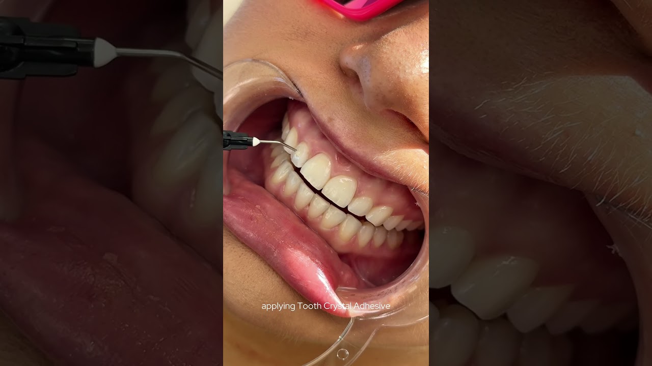 tooth gem: 1 crystal stud 💎 