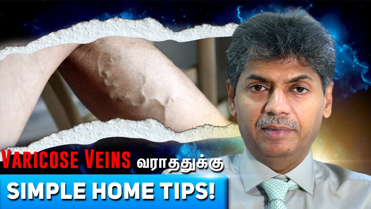 Varicose Veins வராததுக்கு Simple Home Tips! | Dr Bala