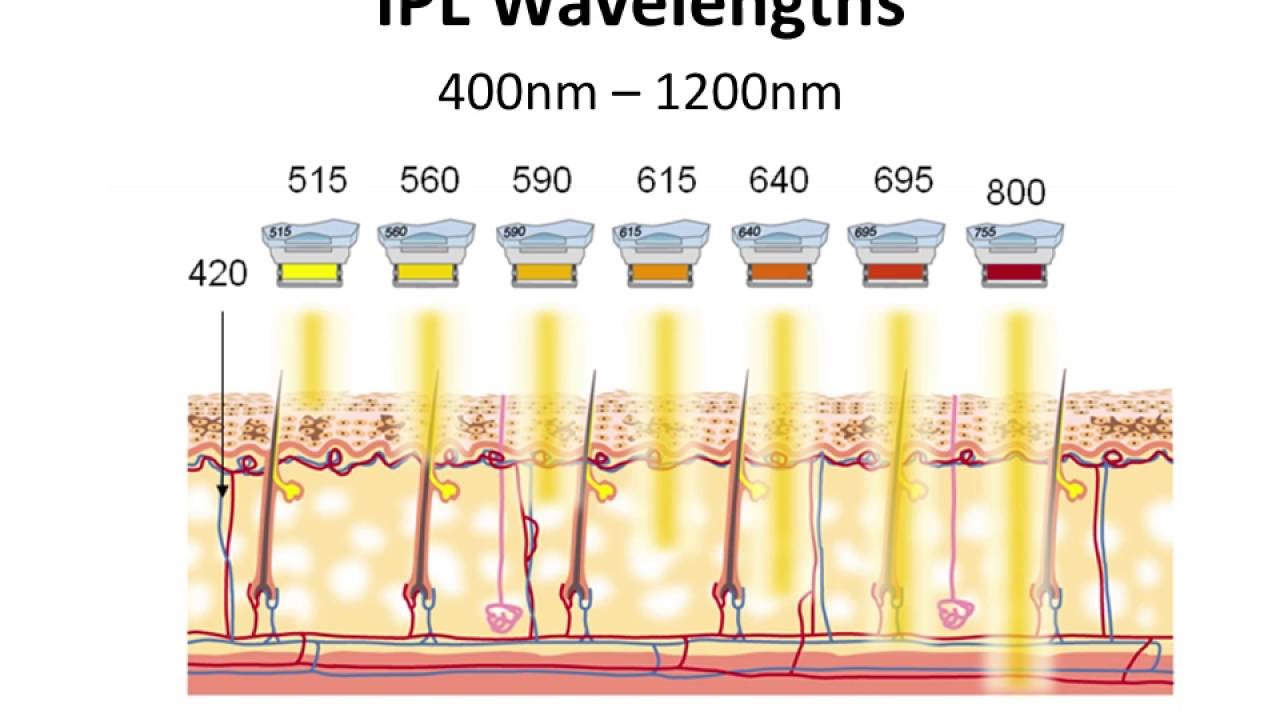 IPL vs LASER