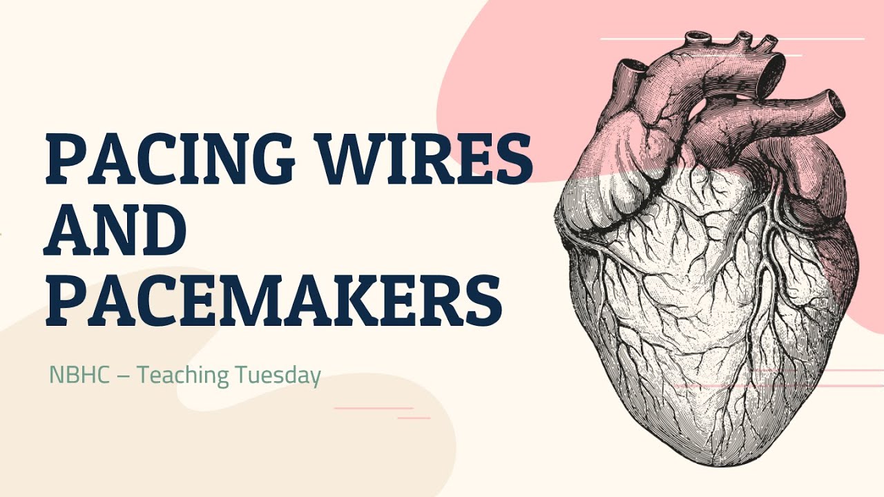 Pacing Wires and Pacemakers