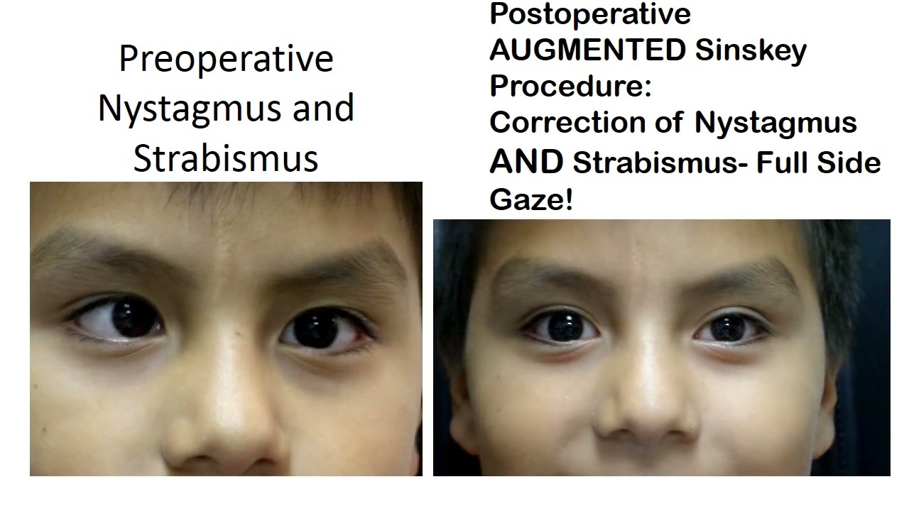 Pre  and Post  Operative findings for the  Augmented Sinskey Procedure  for nystagmus