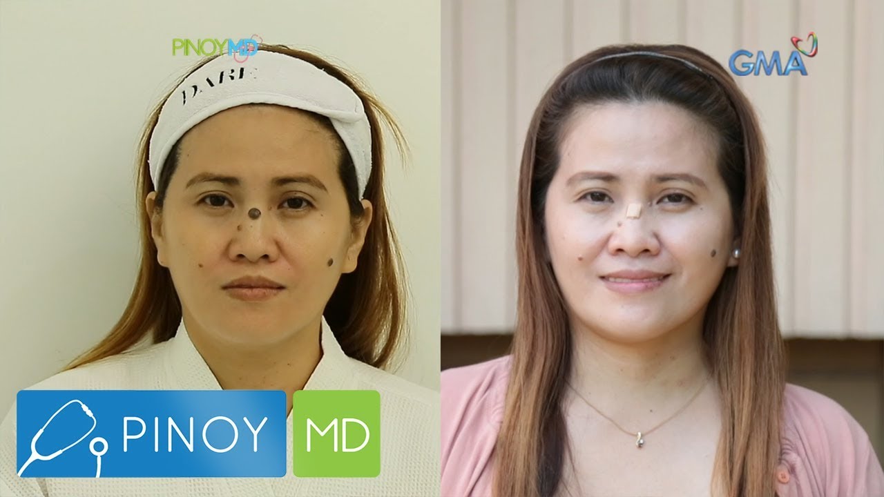 Pinoy MD: Peligro ng 'buhay' na nunal, alamin