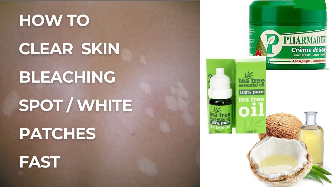 How to clear white patches / Bleaching Spot /Cream reactions / white dot / Skin reaction
