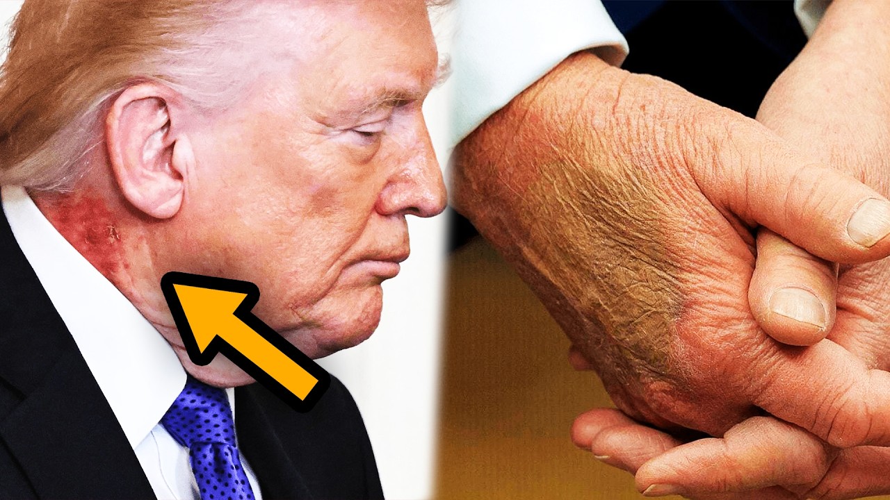 Trump’s neck rot STUNS world