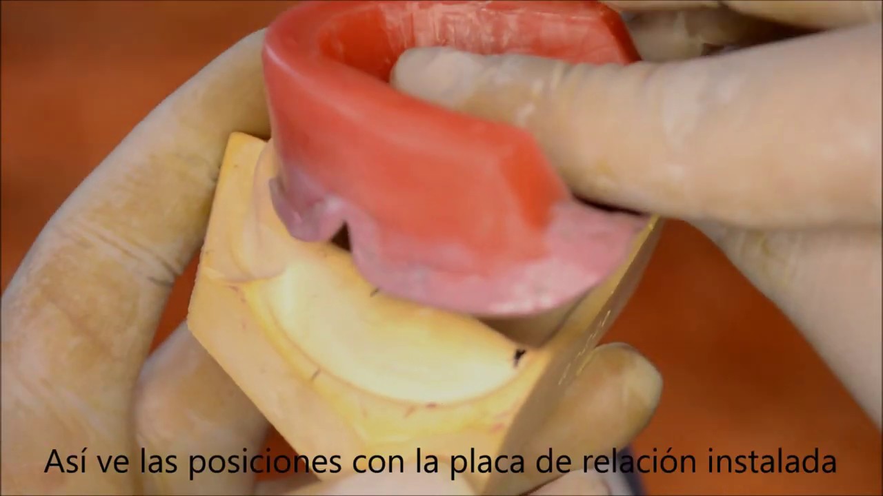 3 Placas de relación desdentado total correcciones finales
