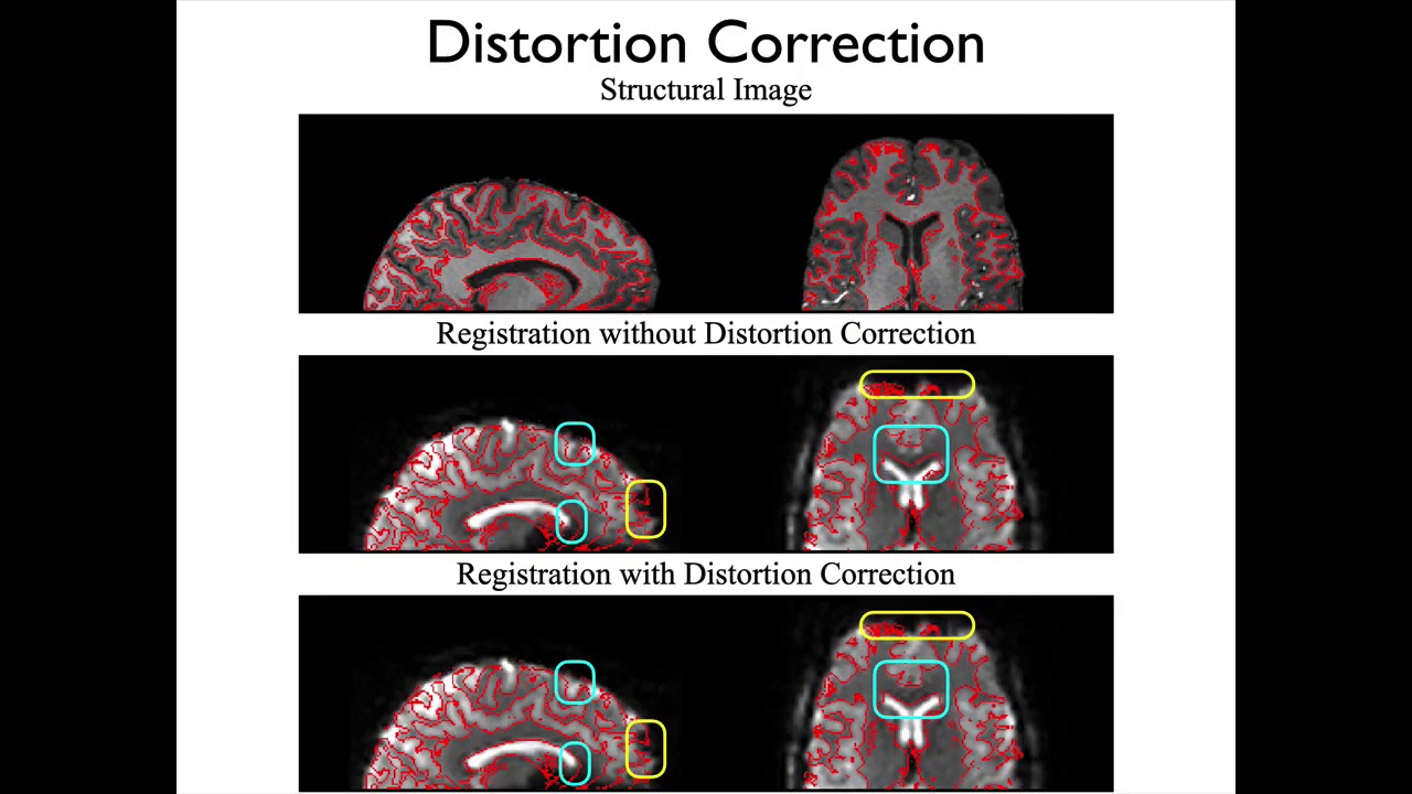 5. Registration: EPI Distortion Correction and Registration (Reg E5)
