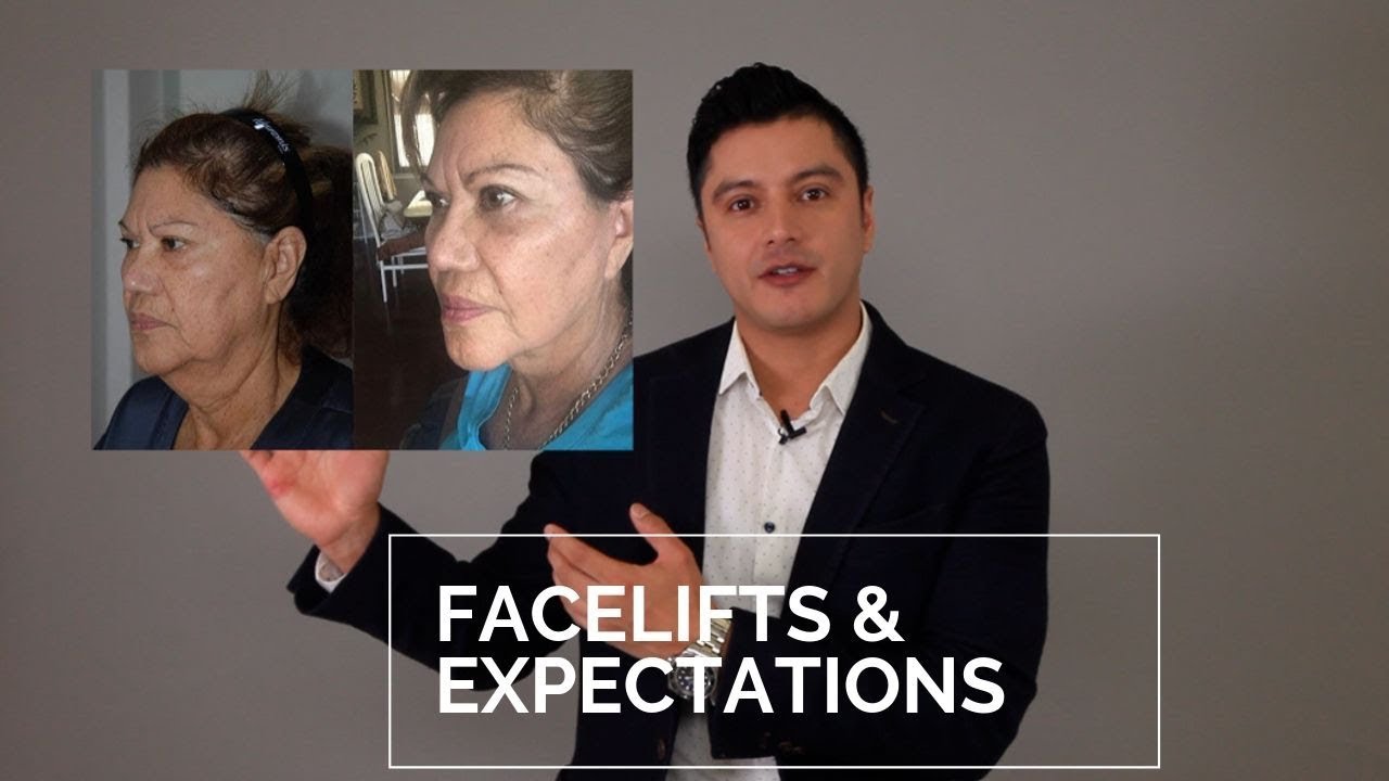 Facelifts & Plastic​ Surgery Expectations | Tony Medina