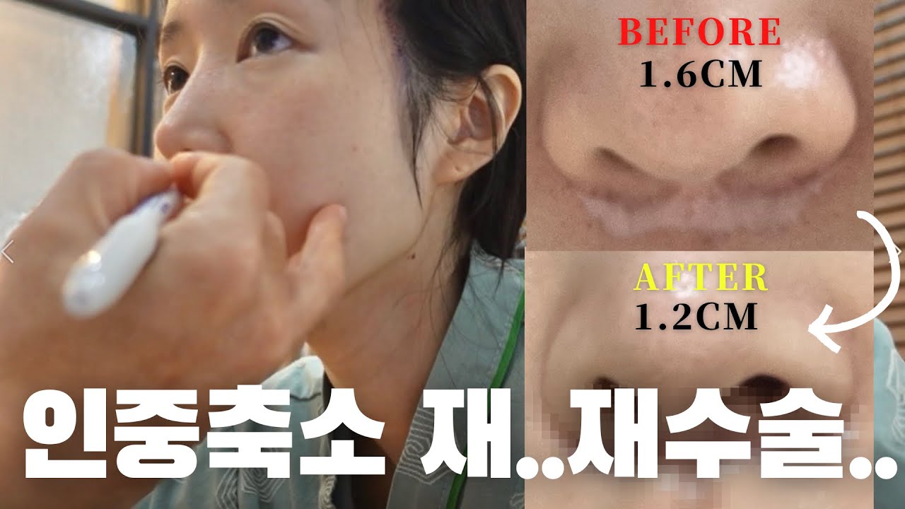 저보다 흉터 심한 사람 못봤어요.. 망한 인중축소 재건 한달차 후기 VLOG 병원 선택 주의사항/흉터연고 추천/약국 붓기 꿀템