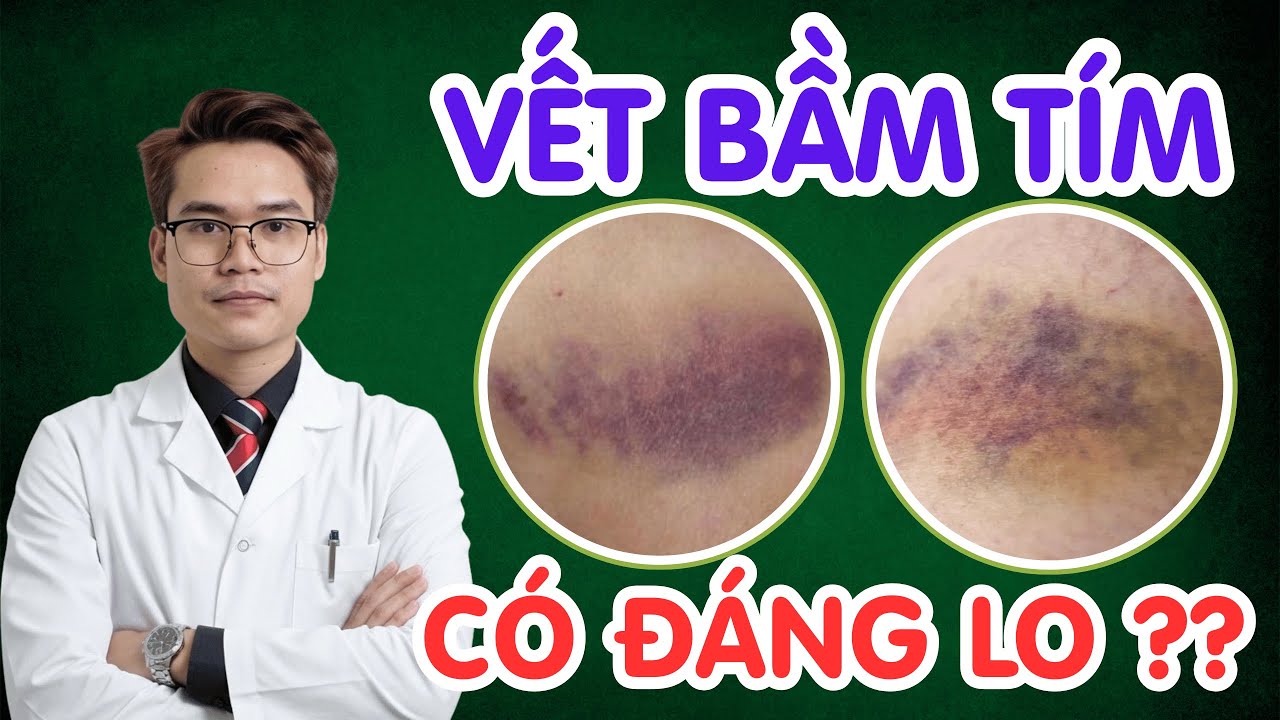 Синяки на коже действительно вызывают беспокойство? Как их лечить дома | Доктор Фам Туан