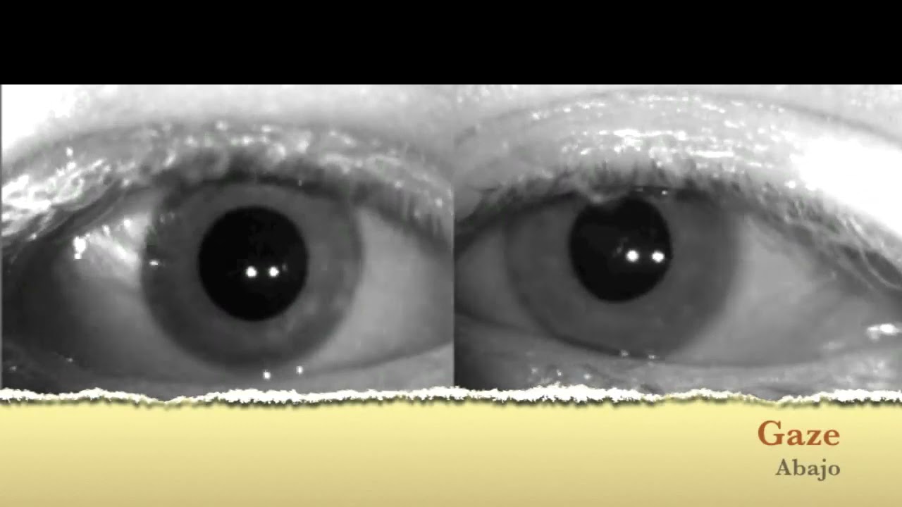 Ocular Flutter in Multiple Sclerosis