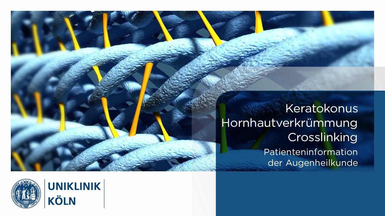 Keratokonus Hornhautverkrümmung - Crosslinking | (Patienteninformation Augenklinik) | Uniklinik Köln