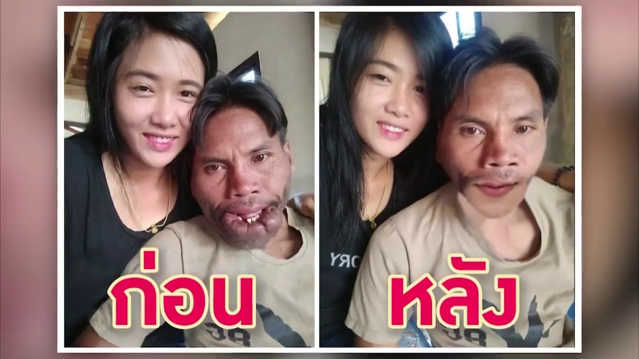 เปิดใจ !! มีมี่ และ บี ที่แรก ดรามาความรัก และการผ่าตัดแปลงโฉม