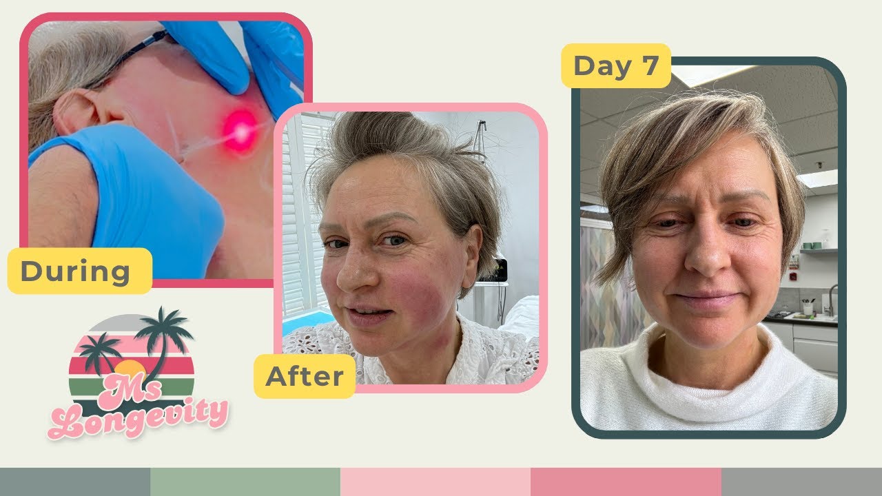 Я сделала Endolift: вот мое 7-дневное восстановление (до и после + реальное время восстановления)