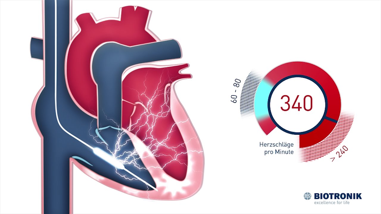 Defibrillator - ICD - Therapie (Animation Medizin)