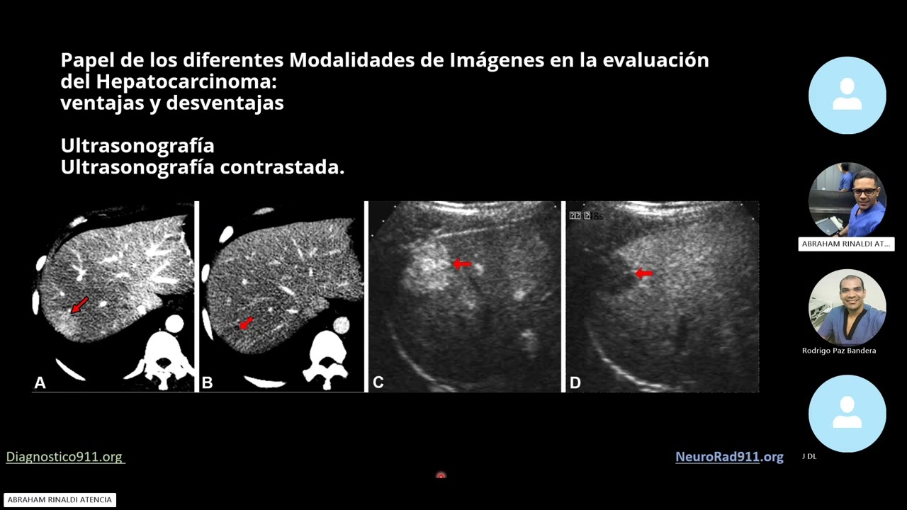 Cirrosis  Imágenes en lesiones benignas y malignas