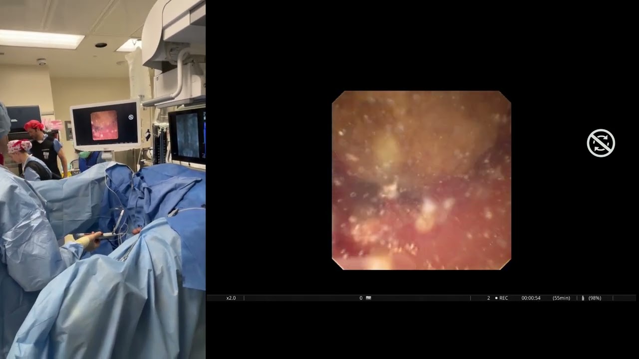 Dr. Sand Showcases Incredible Capabilities with D-URS in Upper and Lower Pole Stone Case