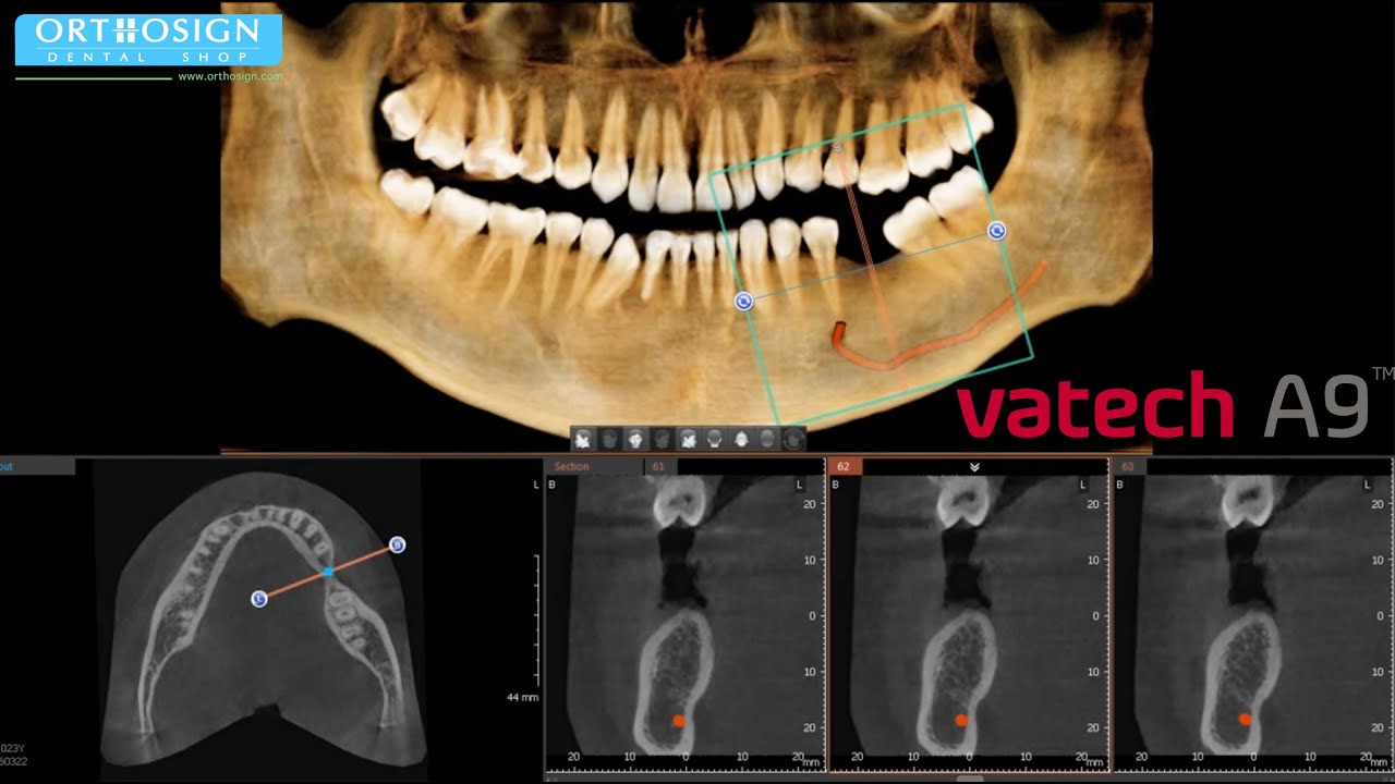 ¿Cómo marcar el Nervio Dentario? en Rayos X 3D Cone Beam Vatech A9 + Panorámico + Ceph - Orthosign